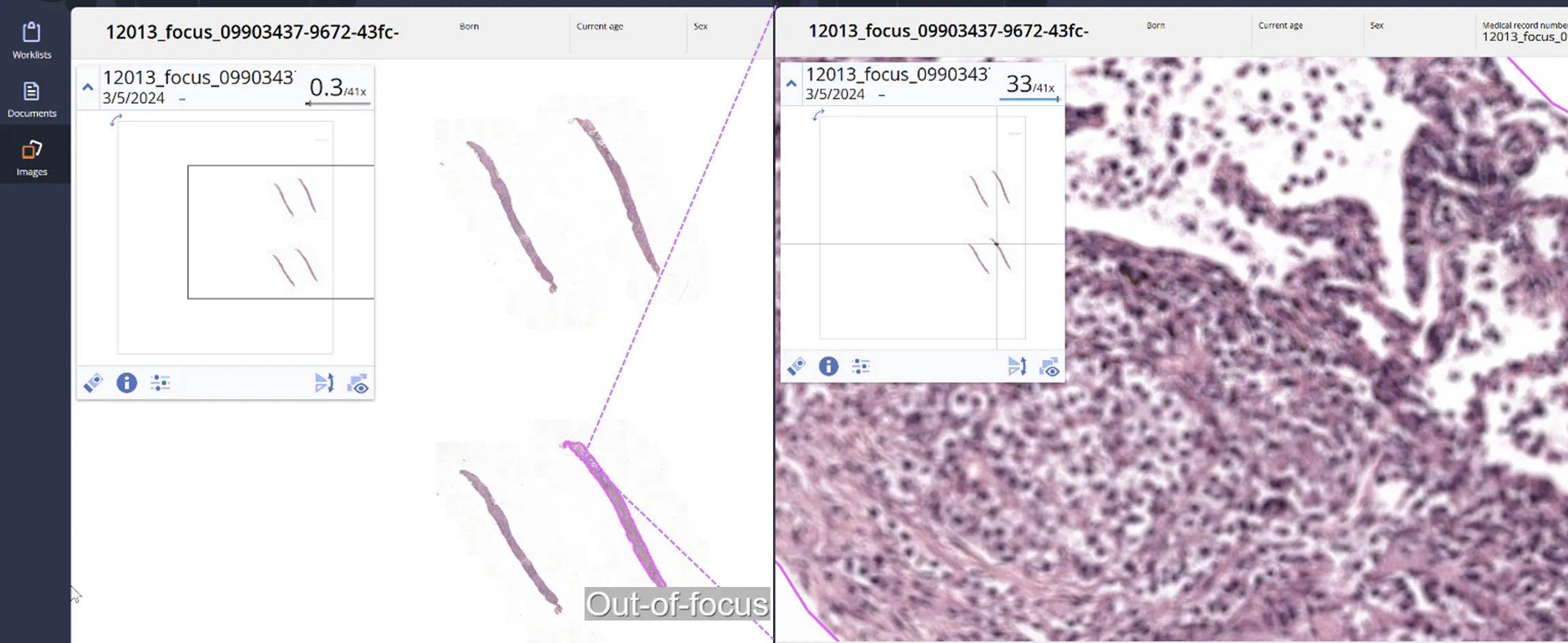 Automated quality control AI output by AiosynQC segmenting out-of-focus regions in an H&amp;E digital histology slide. Left: whole slide image at low magnification with four visible tissue sections, one of them highlighted by AiosynQC. Right: Zoom-in of the segmented region, very visibly out of focus. 