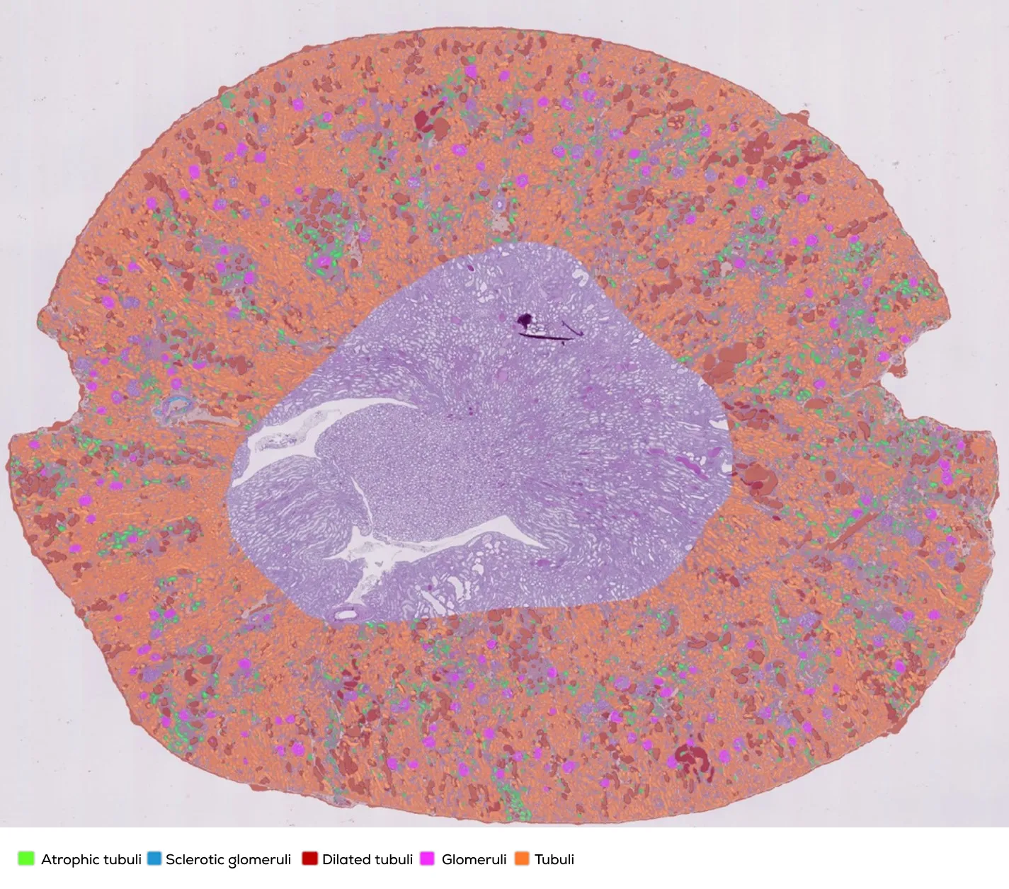 Illustration of the NephroPath platform’s capabilities in performing automated kidney pathology multi-class prediction and quantification on an entire rat kidney cortex (PAS histology slide). Notable classes in the image as indicated in the legend: normal tubules (orange), atrophic/dilated tubules (green/red), glomeruli (pink), abnormal/sclerotic glomeruli (dark blue), arteries (light blue), interstitium (not colored).