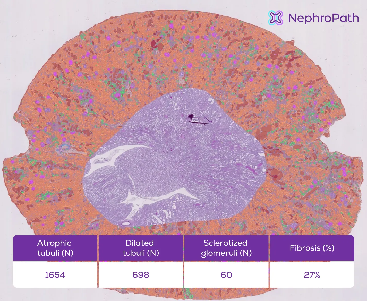 Illustration of the NephroPath platform’s AI kidney disease multi-class prediction and quantification on an entire rat kidney cortex. Notable classes in the digital kidney pathology image: normal tubules (orange), atrophic/dilated tubules (green/red), glomeruli (pink), abnormal/sclerotic glomeruli (dark blue), arteries (light blue), interstitium (not colored). Quantification scores for atrophic tubuli, dilated tubuli, sclerotized glomeruli, and fibrosis are displayed in this image.