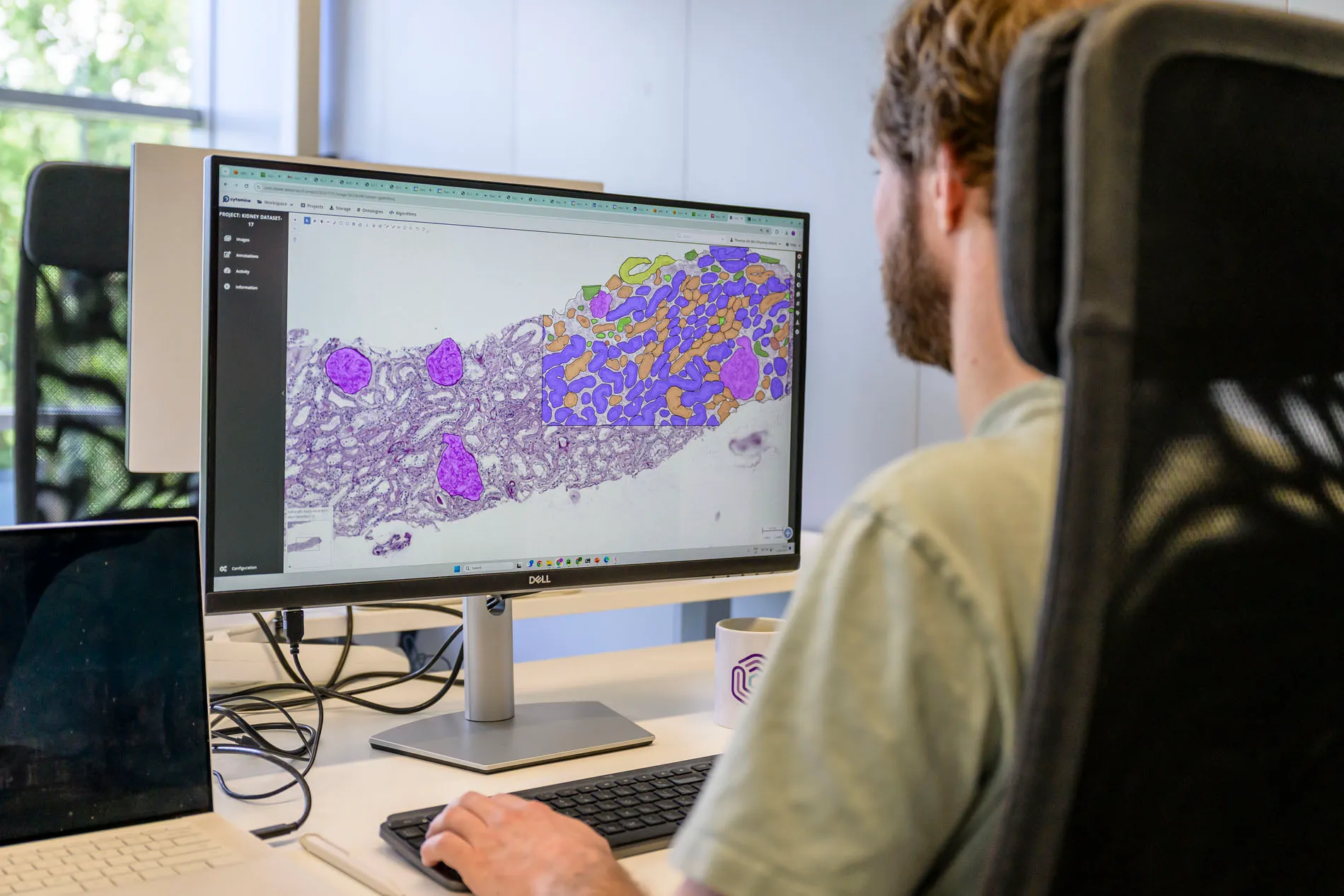 An Aiosyn colleague at a desk, reviewing a kidney section in a slide viewer with the AI's structure annotations drawn over half of the tissue.