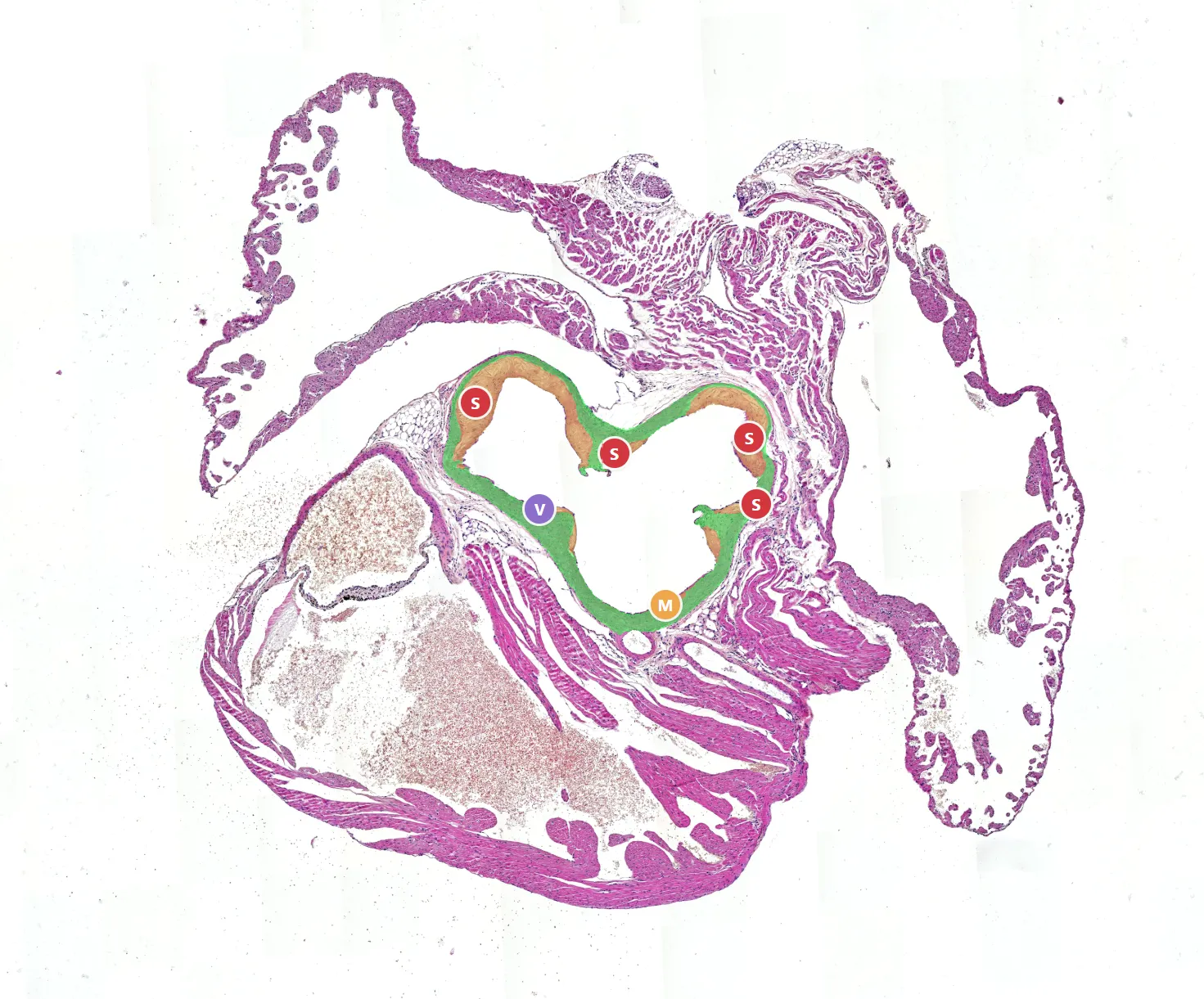 An aortic-root cross-section analyzed by Aiosyn’s atherosclerosis model, with the vessel wall delineated in green, the atherosclerotic lesions in orange, and each lesion marked with a letter for its severity class.