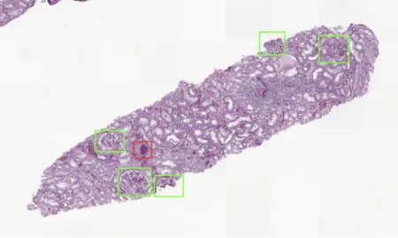 Aiosyn introduces kidney AI platform to revolutionize renal disease research