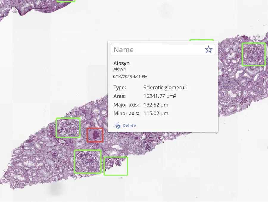 A kidney biopsy read in a slide viewer, with every glomerulus NephroPath GlomeruCount detected outlined, one of them sclerotic, and the viewer reporting its type and area.