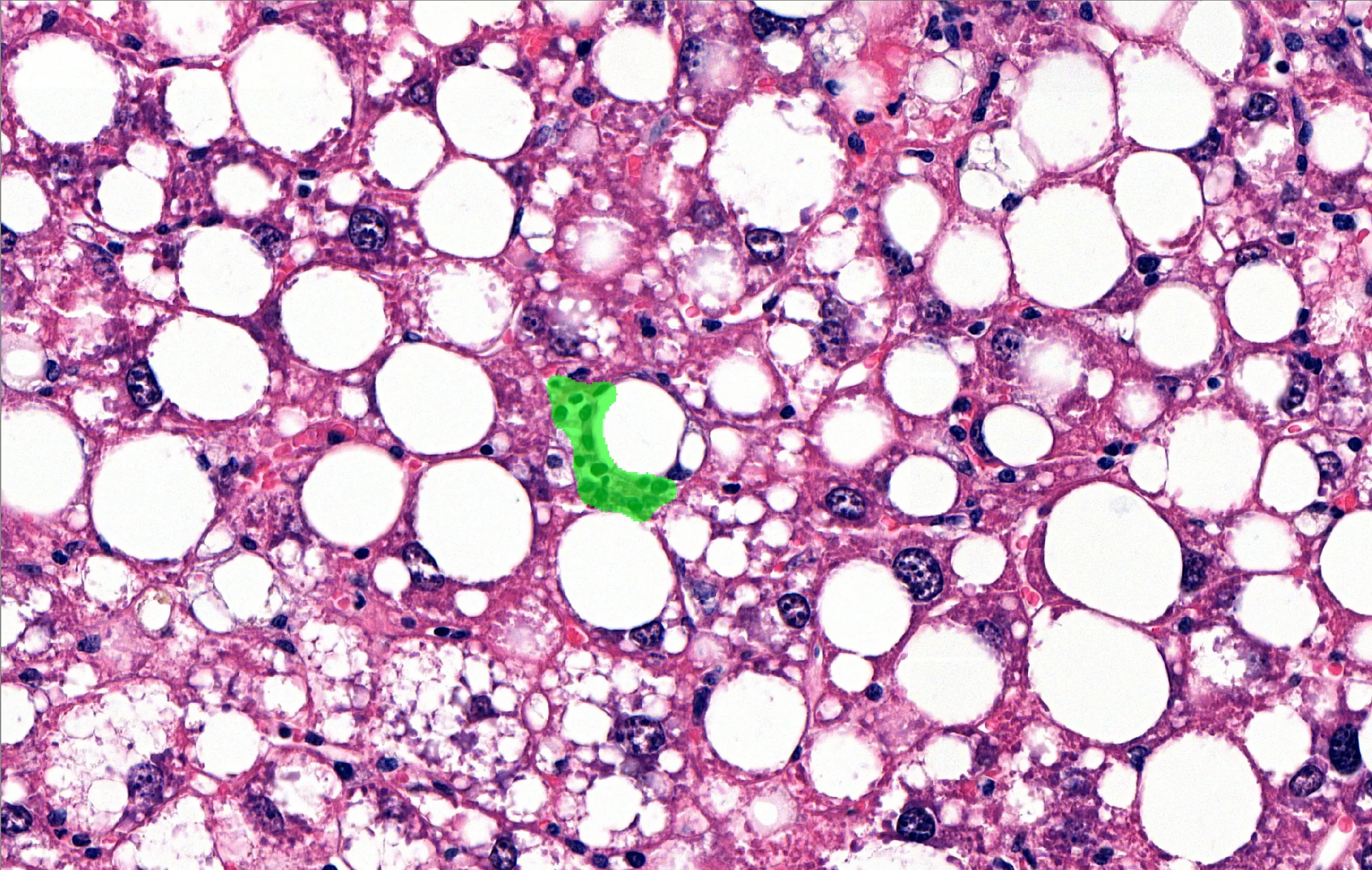 A steatotic liver field with one inflammatory-cell aggregate outlined by the AI.