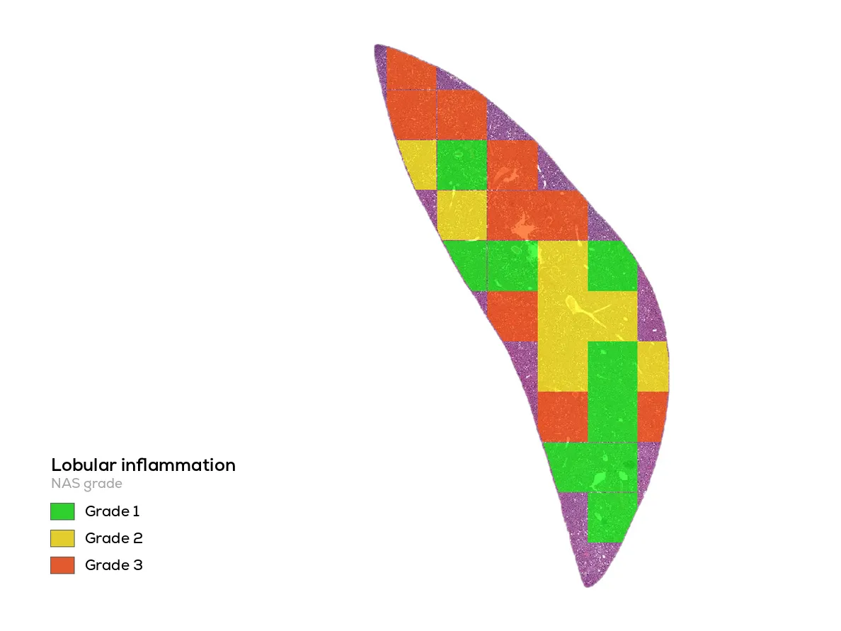 A whole liver section with inflammation density mapped across the tissue as colored tiles.