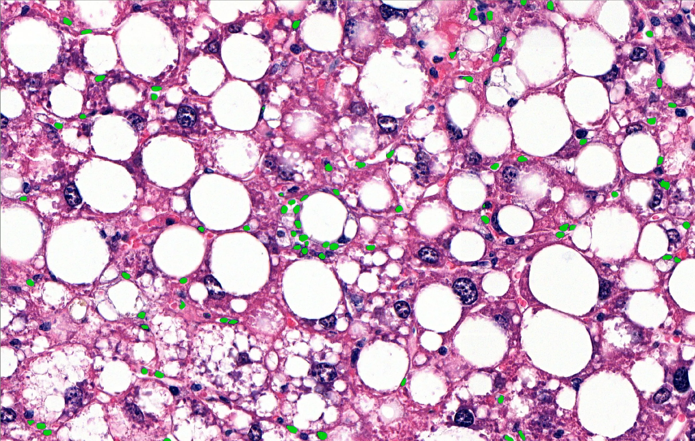 A steatotic liver field with individual inflammatory cells detected and marked one by one.