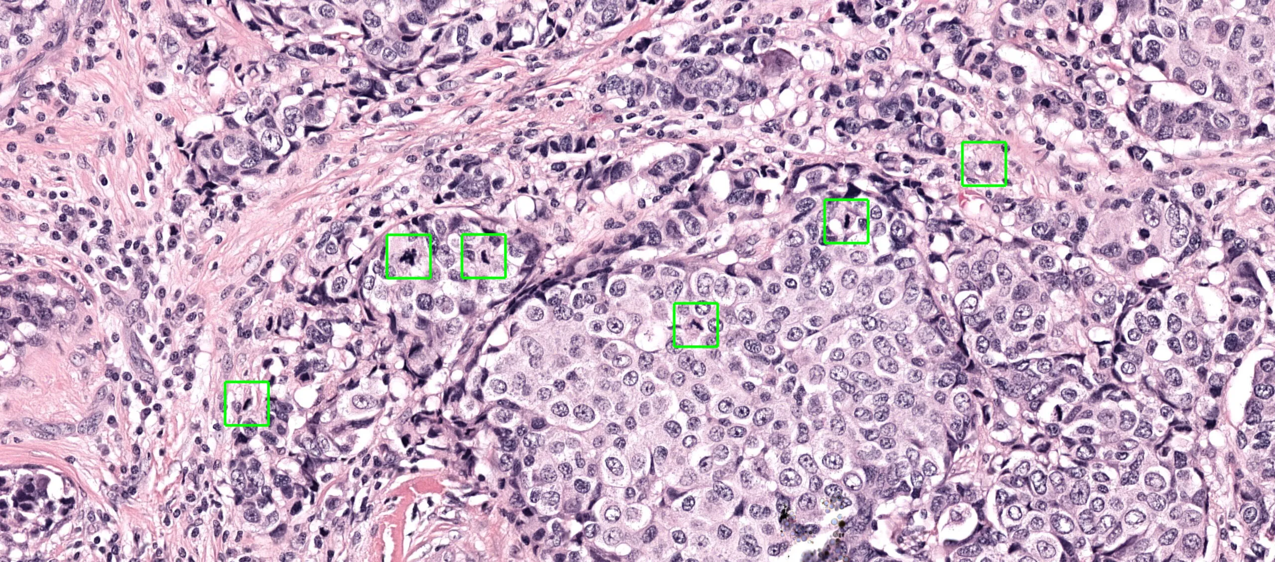 A breast H&E section analyzed by Aiosyn Mitosis Breast, with each detected mitotic figure marked in green.