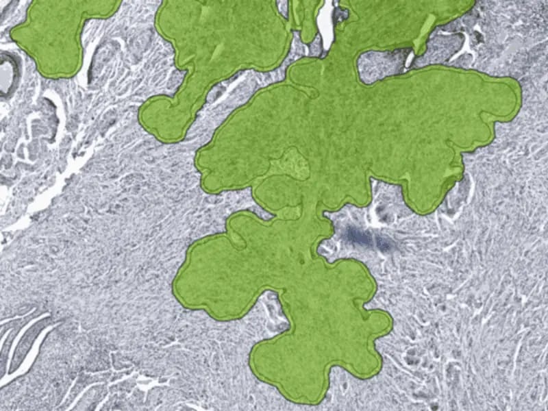 Automated slide QC AI output by AiosynQC segmenting an air bubble in an IHC digital histology slide at medium magnification