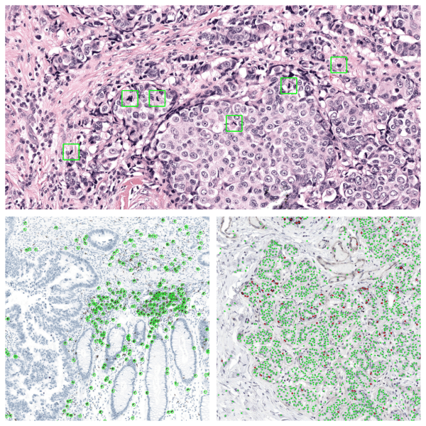 Three examples of the detection of different histopathology features in whole-slide images (one H&E and two IHC) through computational pathology tools.