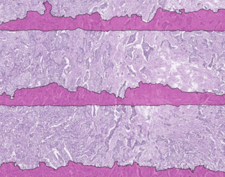 Automated slide QC AI output by AiosynQC segmenting subtle out-of-focus regions in an H&E digital histology slide at medium magnification.