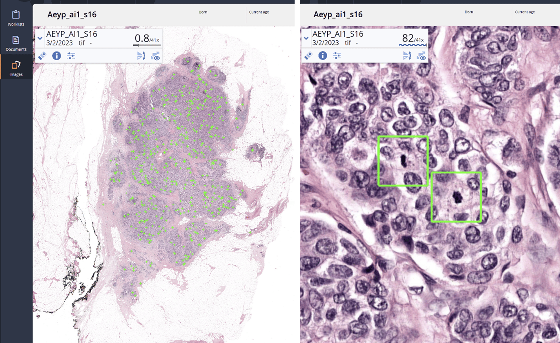 Breast mitosis detection by Aiosyn Mitosis Breast in an H&E digital histology slide. The left image shows the slide at low magnification and the right one at high magnification.
