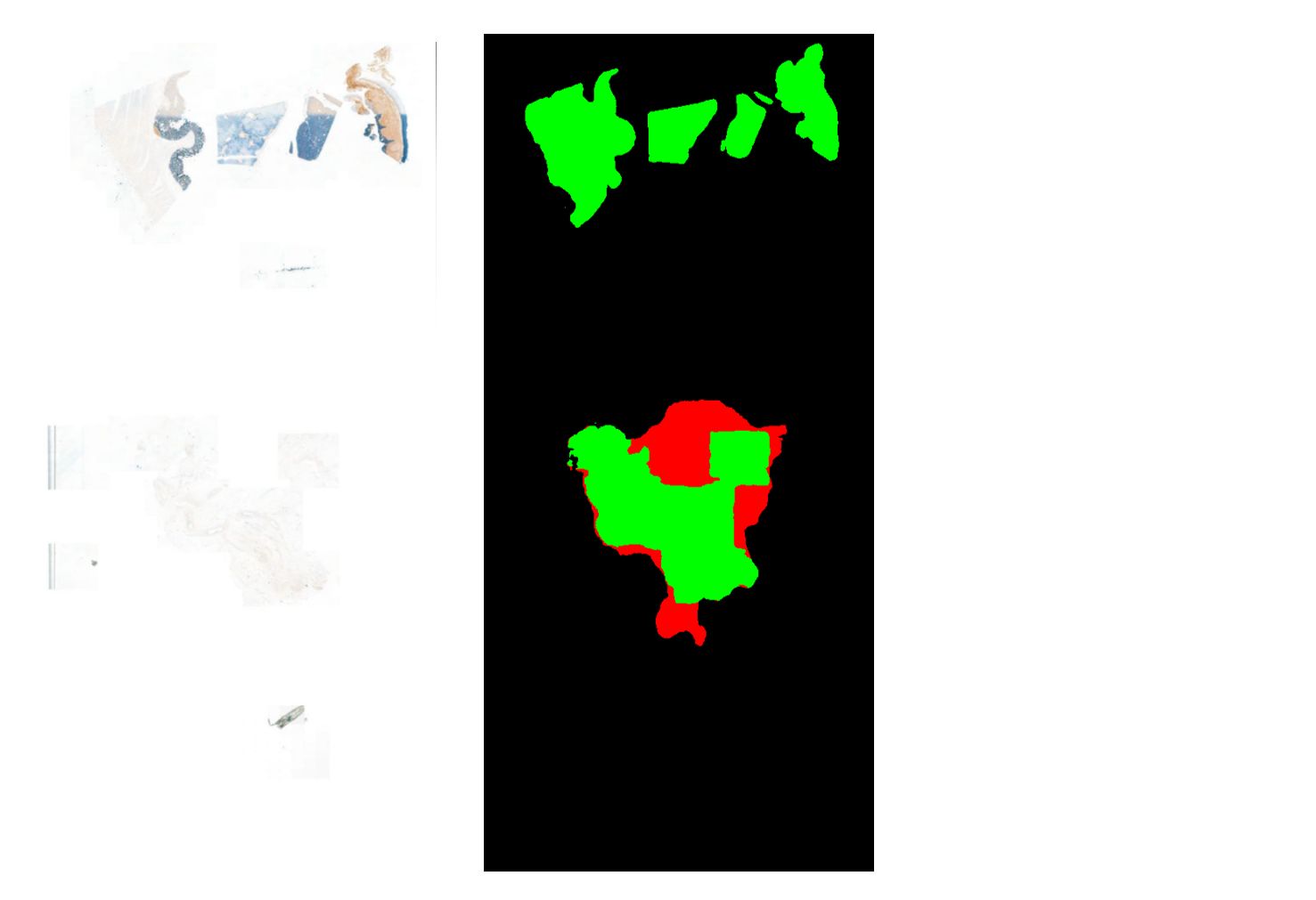 AI artifact detection. Automated slide QC AI output by AiosynQC segmenting an out-of-focus tissue section in an H&E digital histology slide at low magnification