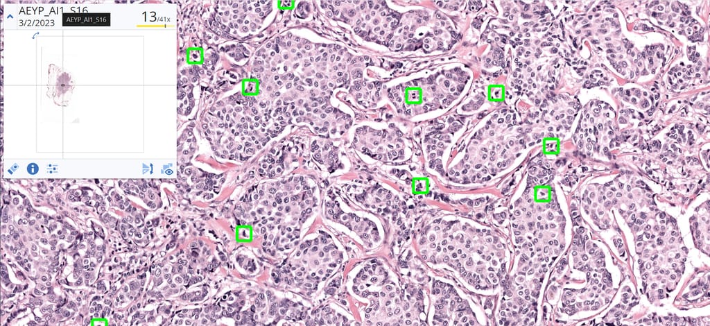 Deep-learning breast cancer mitosis detection output by Aiosyn Mitosis Breast in an H&E histology digital slide at medium magnification