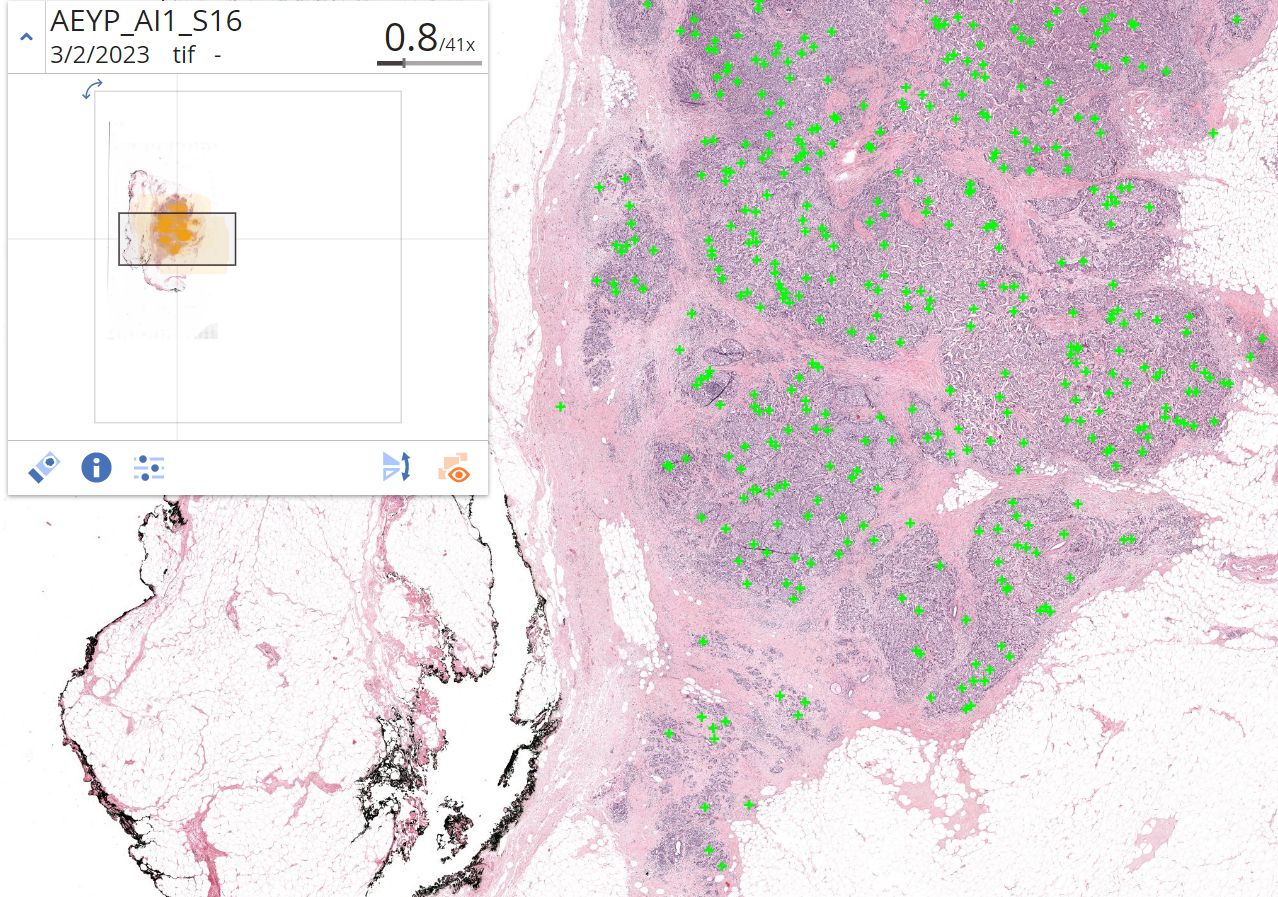 Mitotic figures are identified and highlighted in a digital histology slide with AI-powered Aiosyn Mitosis Breast