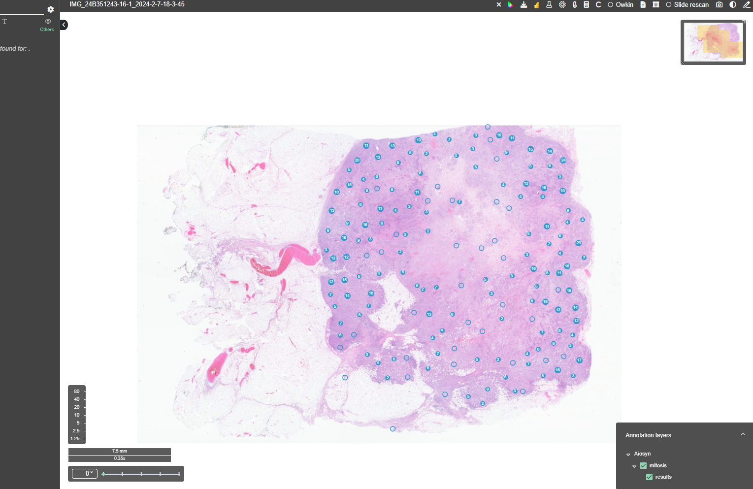 Automated mitotic figure identification on a breast H&E whole-slide image. Aiosyn Mitosis Breast, integrated with the Telemis TM-Microscopy solution, provides AI-powered detection and highlighting of mitotic figures.